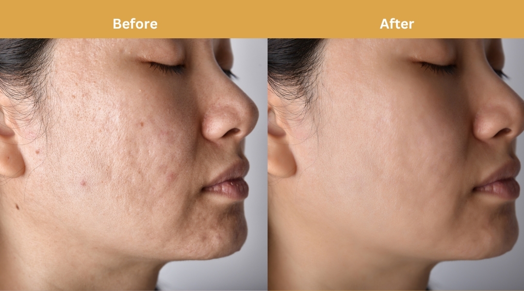 MNRF treatment result at Dermatonik, HSR Layout, Bangalore