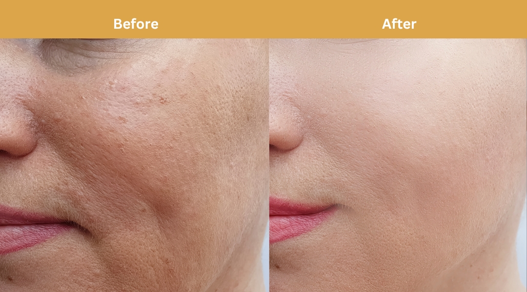 Carbon laser facial result at Dermatonik, HSR Layout, Bangalore