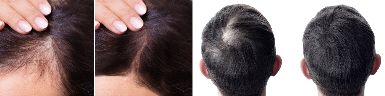Hair regrowth GFC