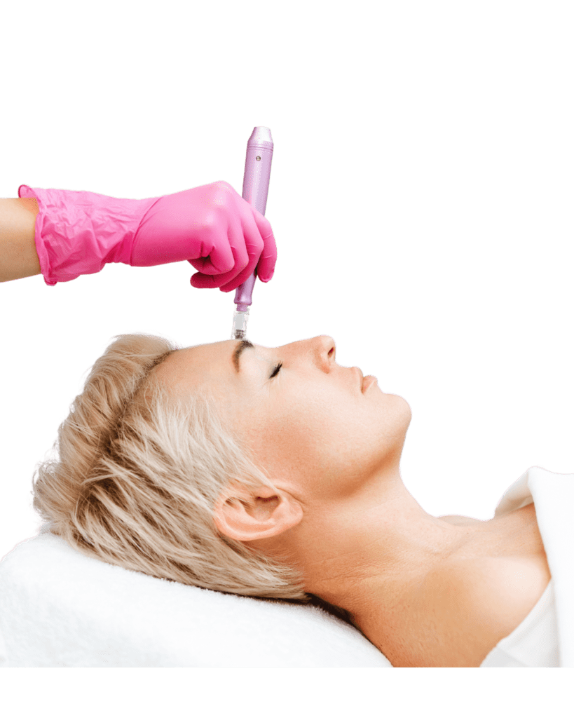 microneedling