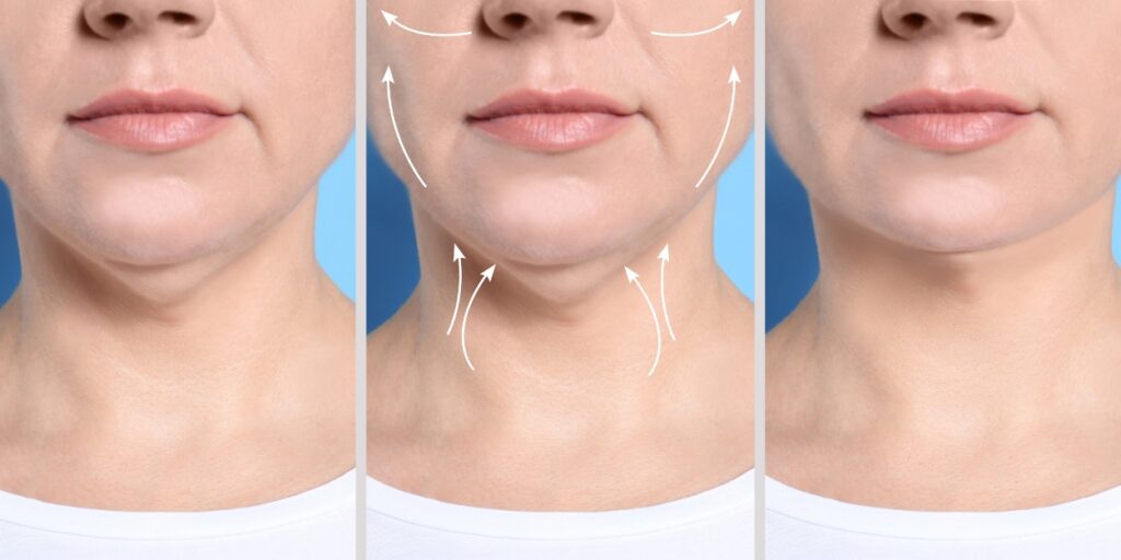lift face with filler