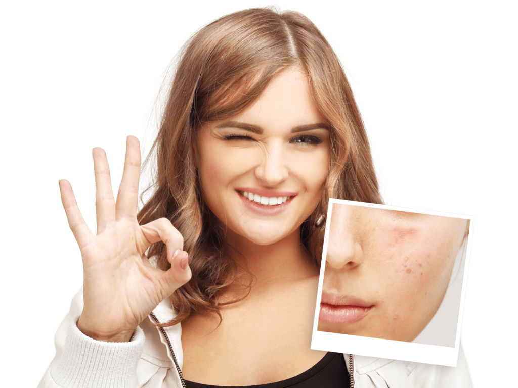 acne treatment