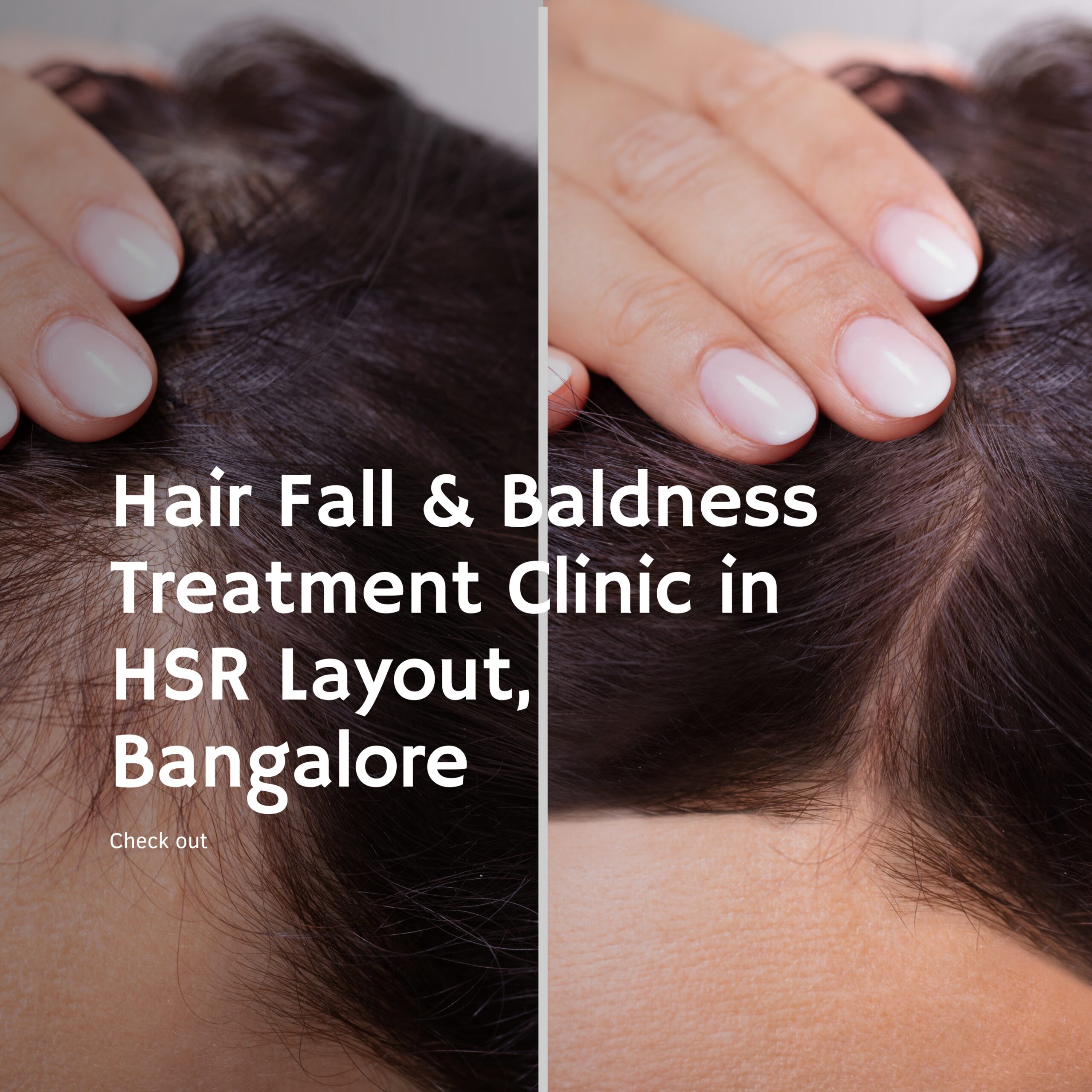 Hair Fall & Baldness Treatment Clinic in HSR Layout, Bangalore