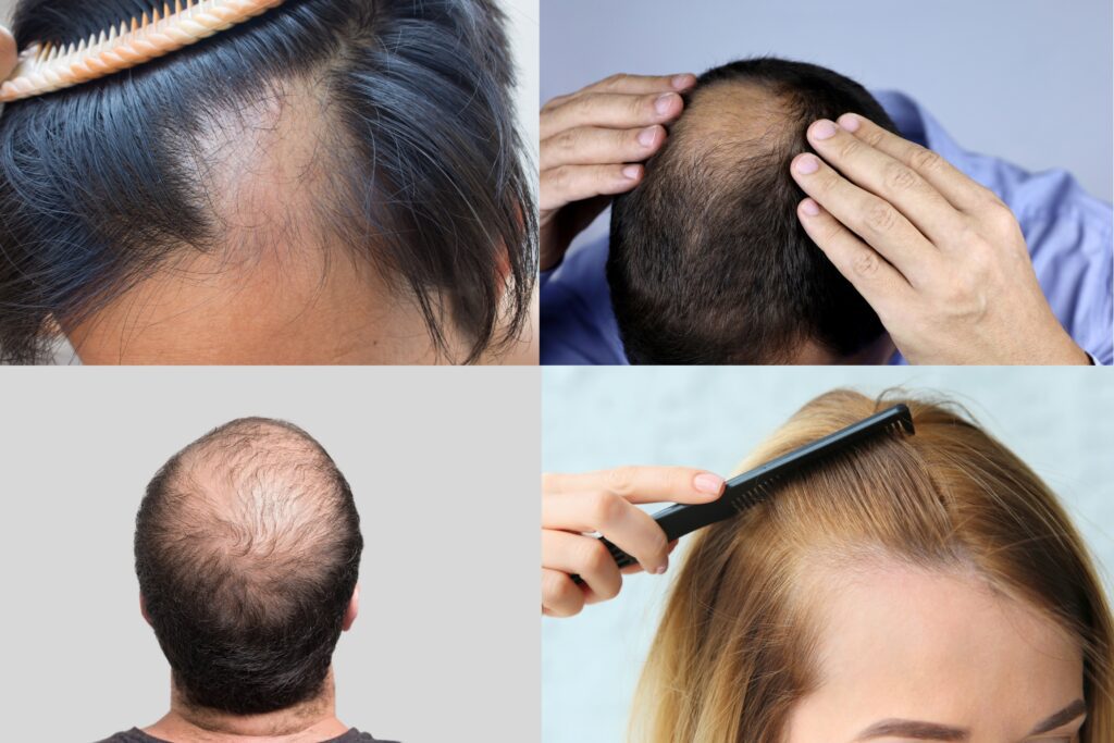 types of hair loss
