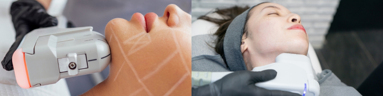 HIFU chin reduction at HSR layout