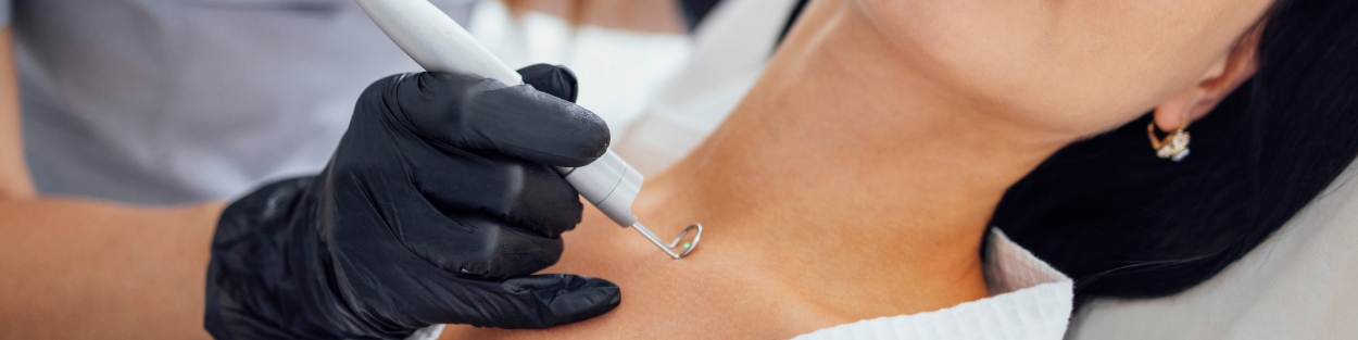 Warts and Skin Tags