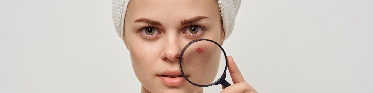 acne treatment