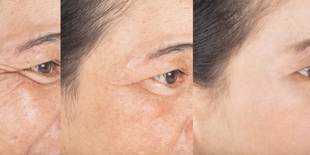 wrinkle treatment