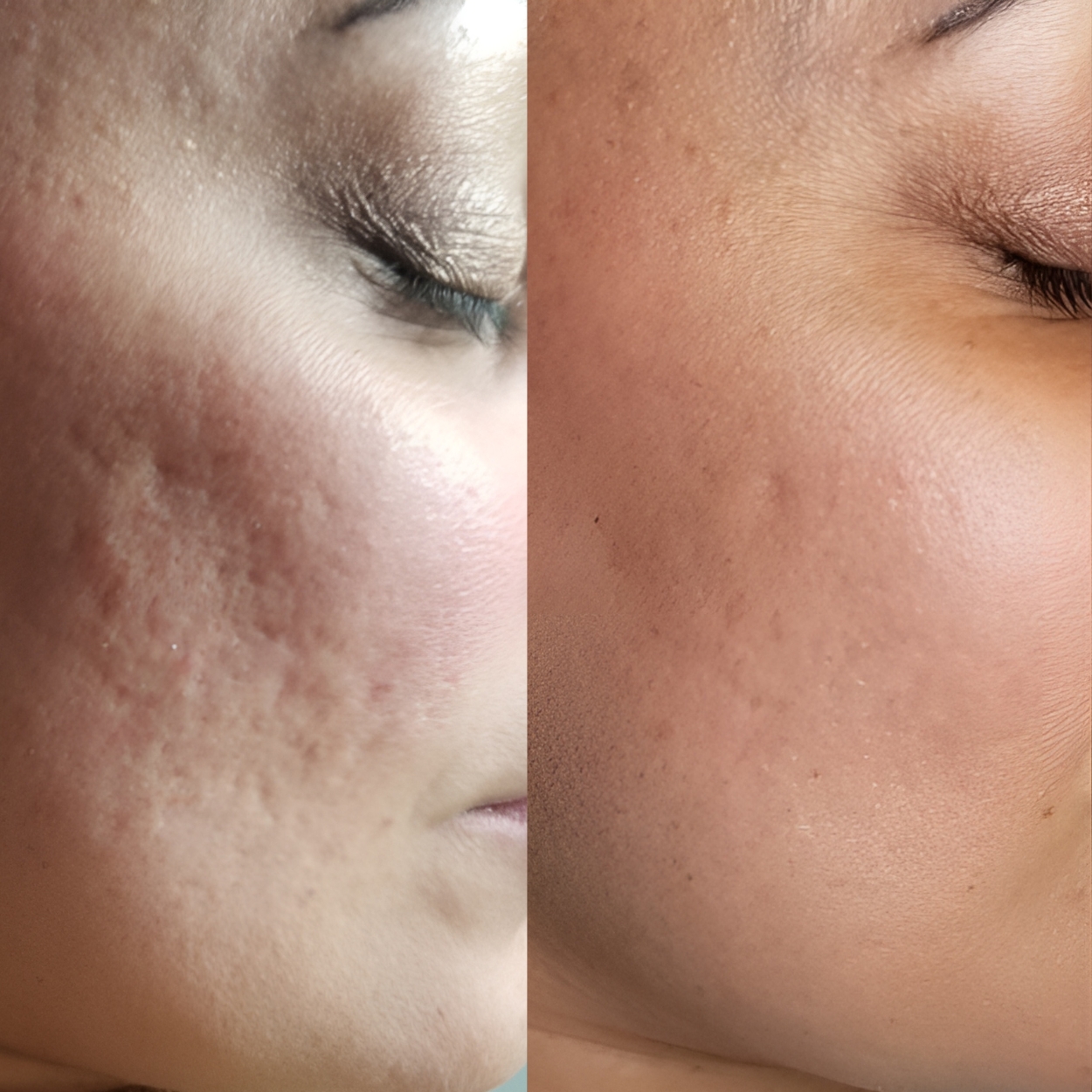 Acne Treatment (Acne & Acne Scar Treatment)