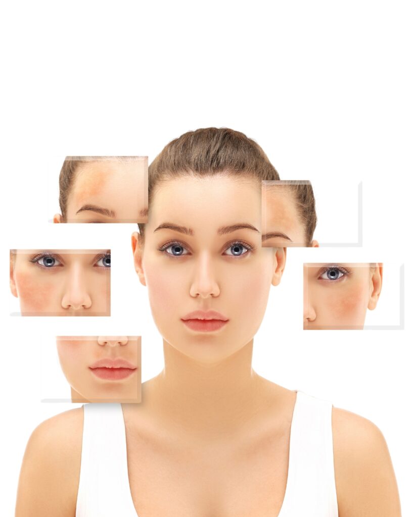hyperpigmentation