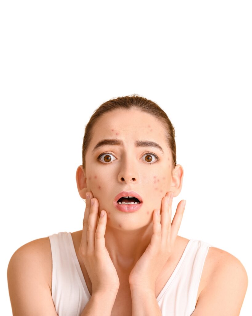 acne treatment