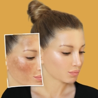 Melasma