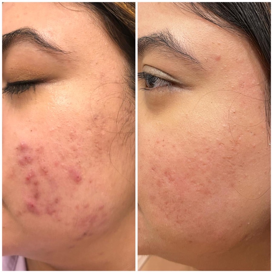 Before and after pigmentation care — post-acne marks on Indian skin