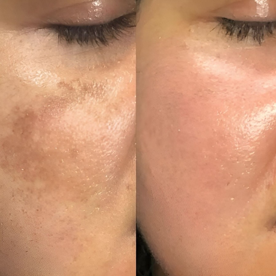 Before and after pigmentation care — uneven skin tone on Indian skin